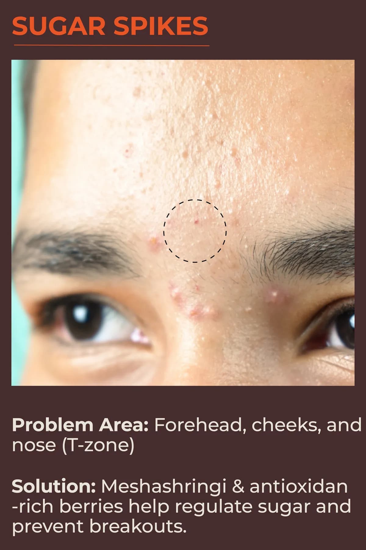 Sugar spikes: forehead, cheeks and T-zone. Meshashringi and antioxidant-rich berries help regulate sugar